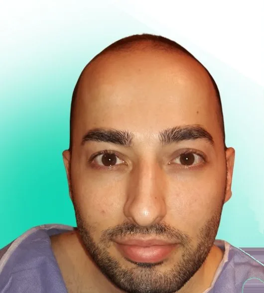 قبل زراعة الشعر، من الأمام