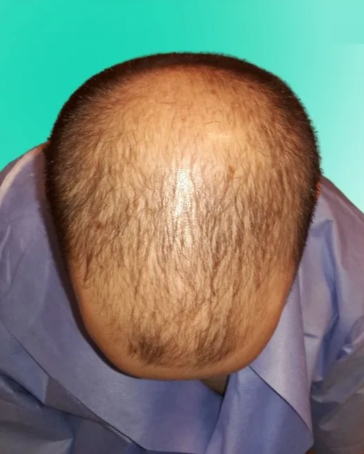 قبل زراعة الشعر، من الأعلى