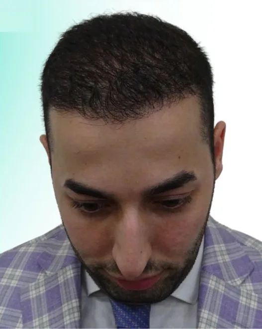 بعد زراعة الشعر، من الأعلى