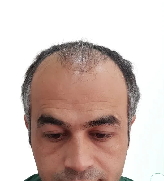 قبل زراعة الشعر، من الأمام