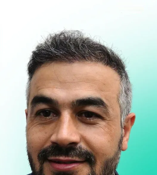 بعد زراعة الشعر، من الأمام