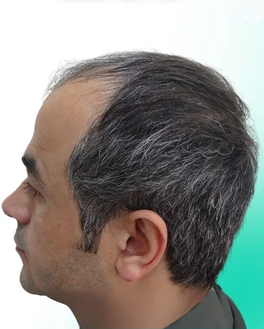 قبل زراعة الشعر، من الأعلى