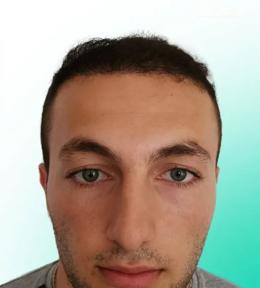 بعد زراعة الشعر، من الأمام