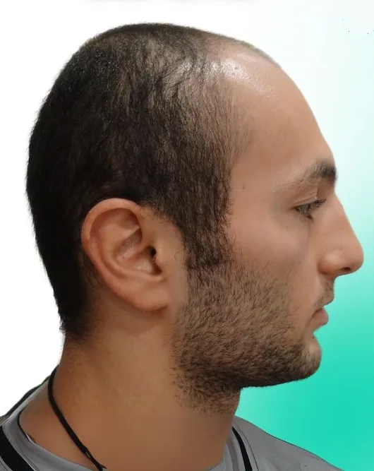 قبل زراعة الشعر، من الأعلى