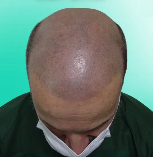 قبل زراعة الشعر، من الأعلى