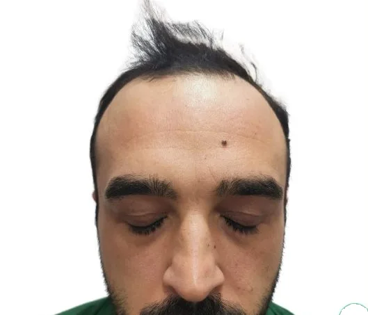 قبل زراعة الشعر، من الأمام