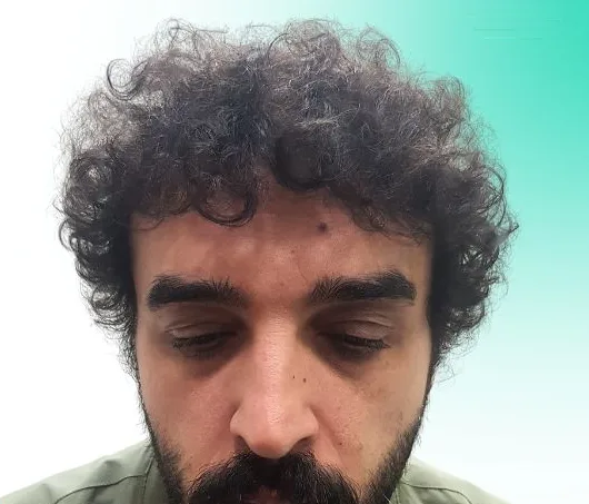 بعد زراعة الشعر، من الأمام