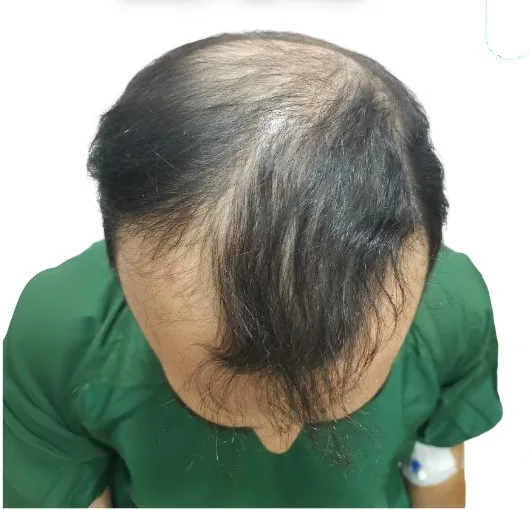 قبل زراعة الشعر، من الأعلى