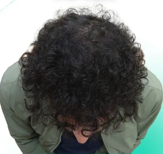 بعد زراعة الشعر، من الأعلى
