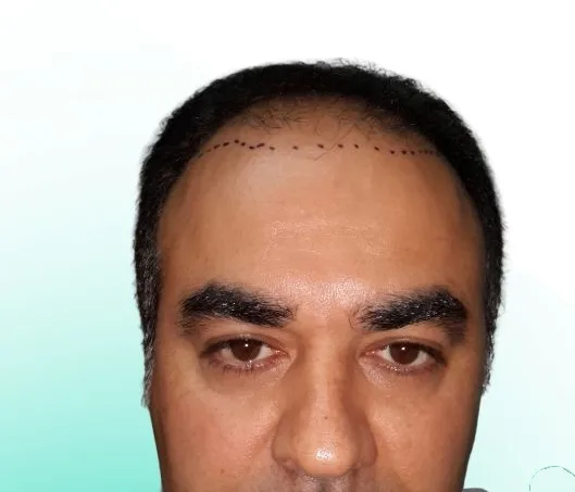 قبل زراعة الشعر، من الأمام