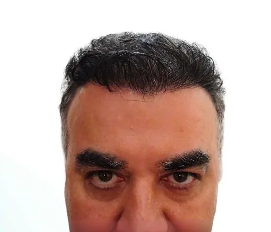 بعد زراعة الشعر، من الأمام