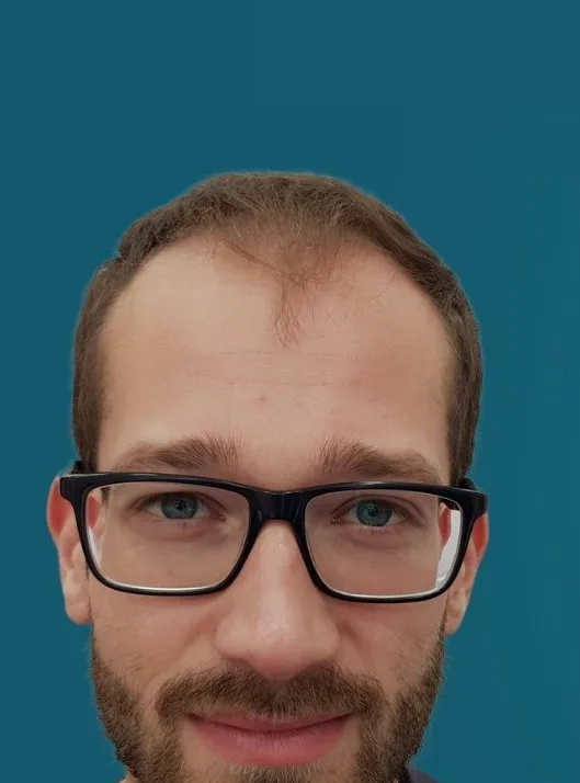 قبل زراعة الشعر، من الأمام
