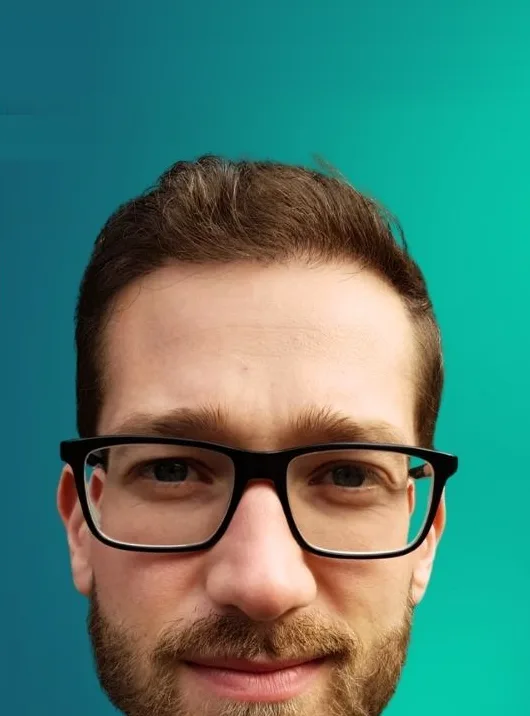 بعد زراعة الشعر، من الأمام