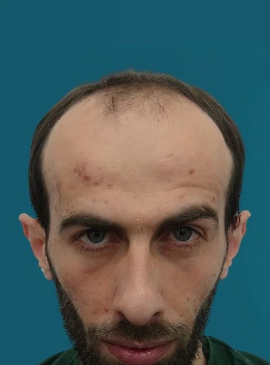 قبل زراعة الشعر، من الأمام