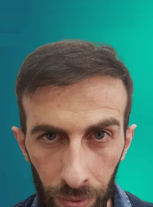 بعد زراعة الشعر، من الأمام