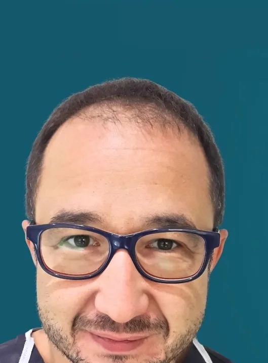 قبل زراعة الشعر، من الأمام