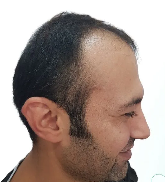 قبل زراعة الشعر، من الأمام