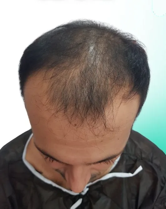 قبل زراعة الشعر، من الأعلى
