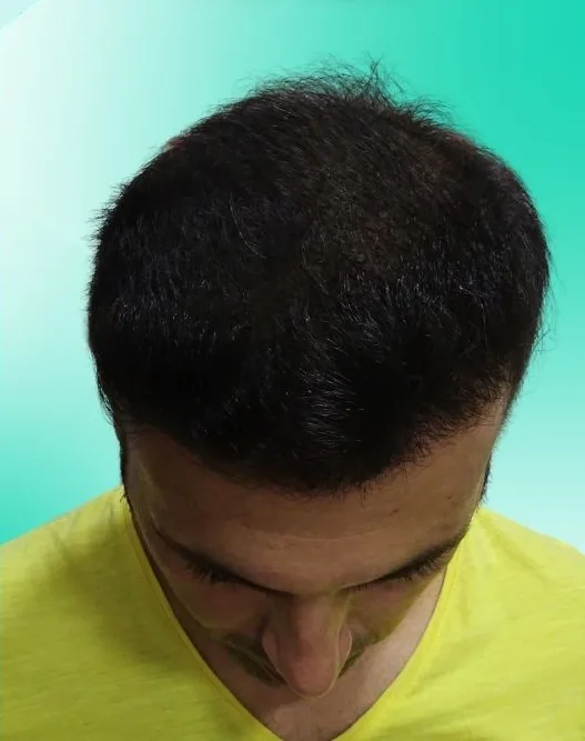 بعد زراعة الشعر، من الأعلى