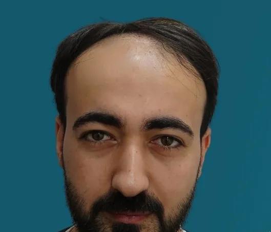 قبل زراعة الشعر، من الأمام