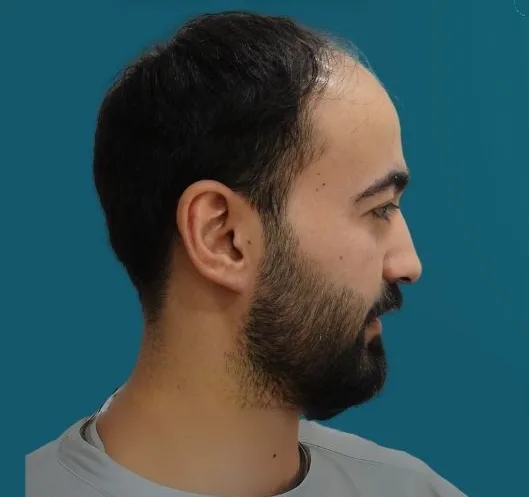 قبل زراعة الشعر، من الأعلى