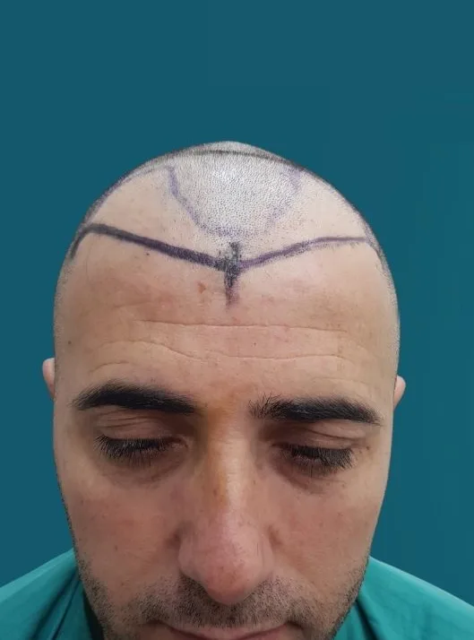 قبل زراعة الشعر، من الأمام