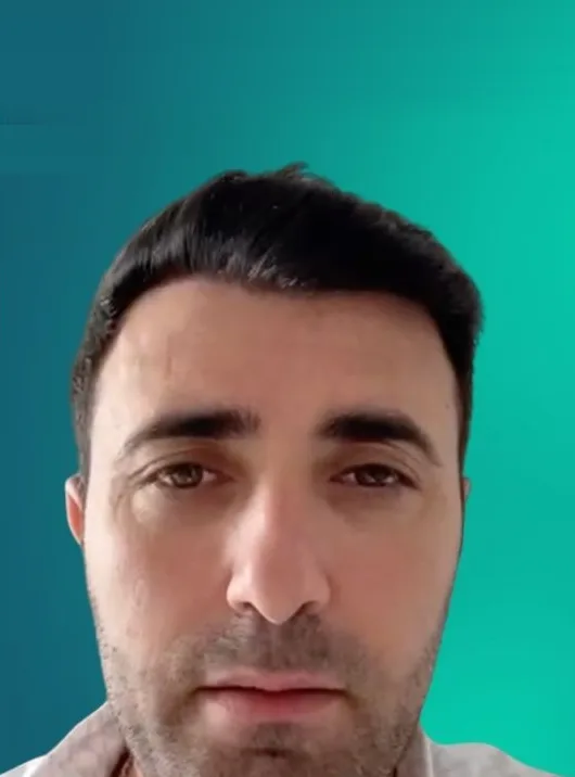 بعد زراعة الشعر، من الأمام