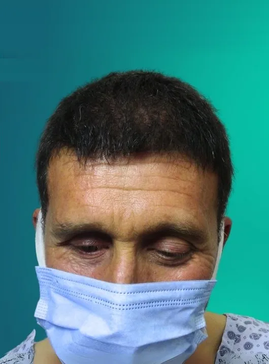 بعد زراعة الشعر، من الأمام