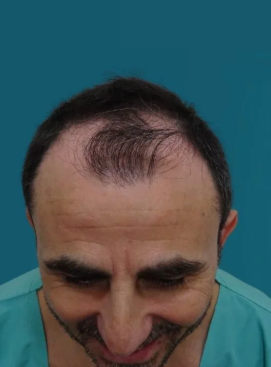 قبل زراعة الشعر، من الأمام
