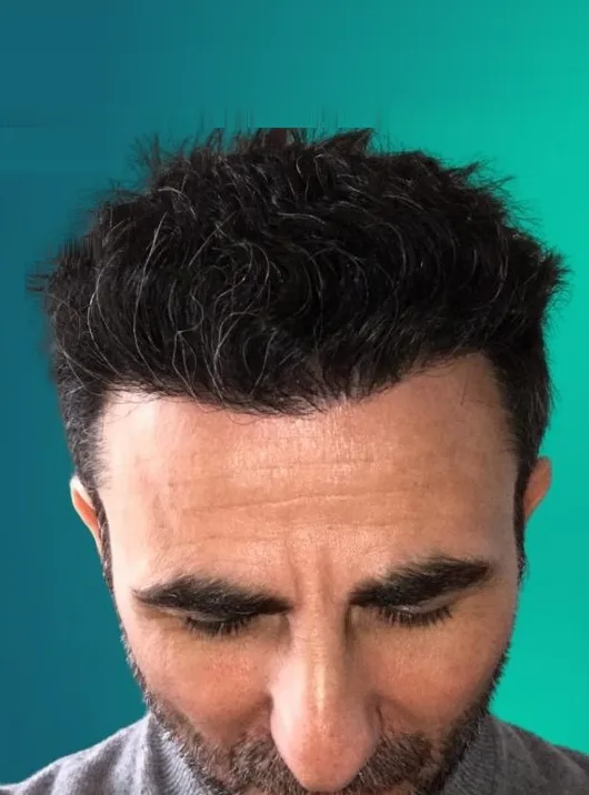 بعد زراعة الشعر، من الأمام
