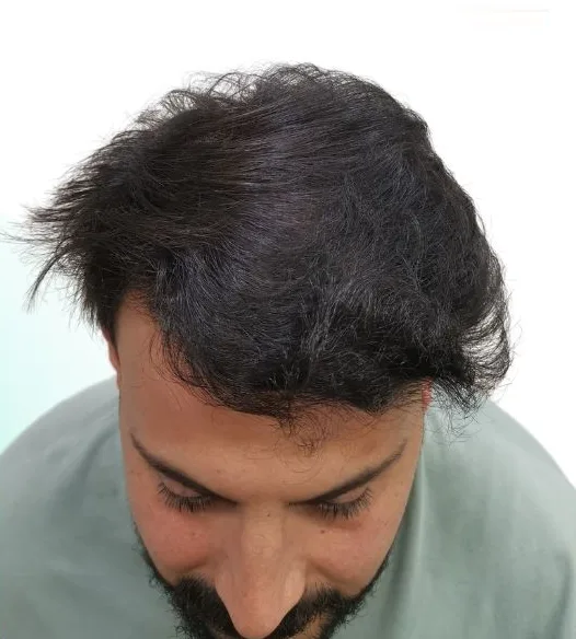 بعد زراعة الشعر، من الأمام