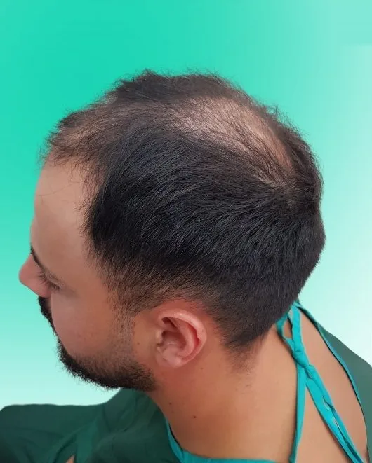 قبل زراعة الشعر، من الأعلى