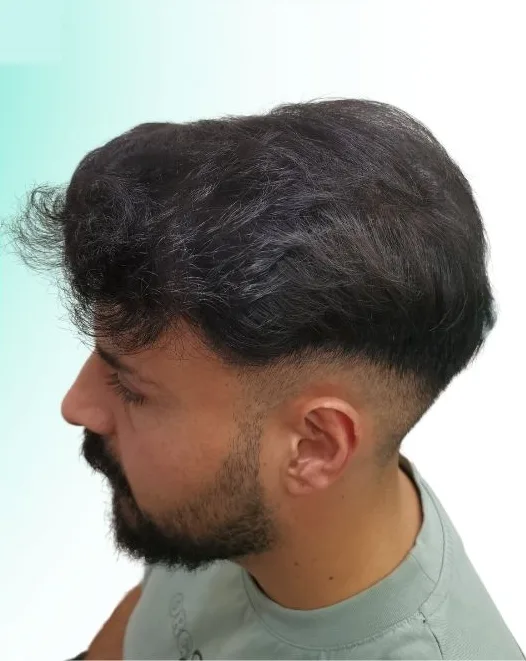 بعد زراعة الشعر، من الأعلى