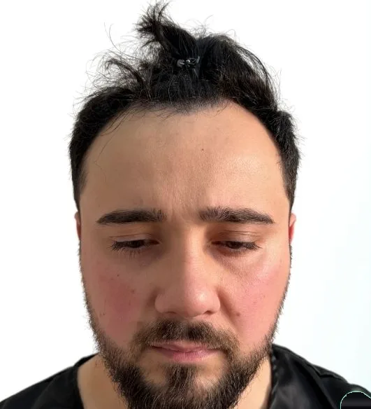 قبل زراعة الشعر، من الأمام