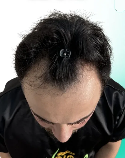 قبل زراعة الشعر، من الأعلى