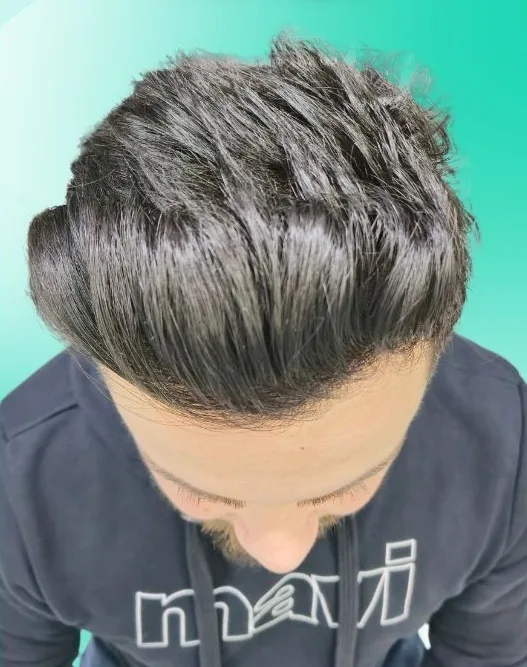 بعد زراعة الشعر، من الأعلى