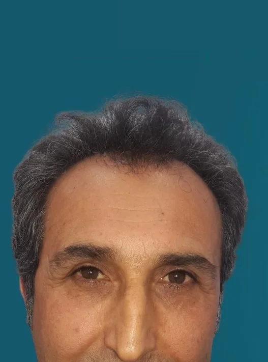 قبل زراعة الشعر، من الأمام