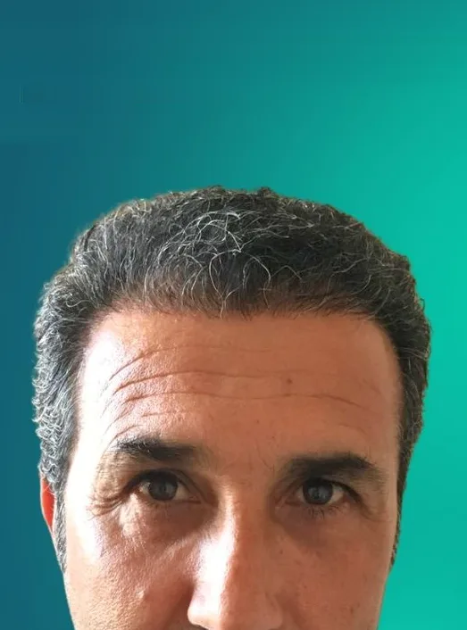 بعد زراعة الشعر، من الأمام