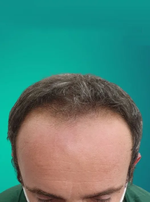 قبل زراعة الشعر، من الأمام