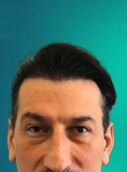 بعد زراعة الشعر، من الأمام