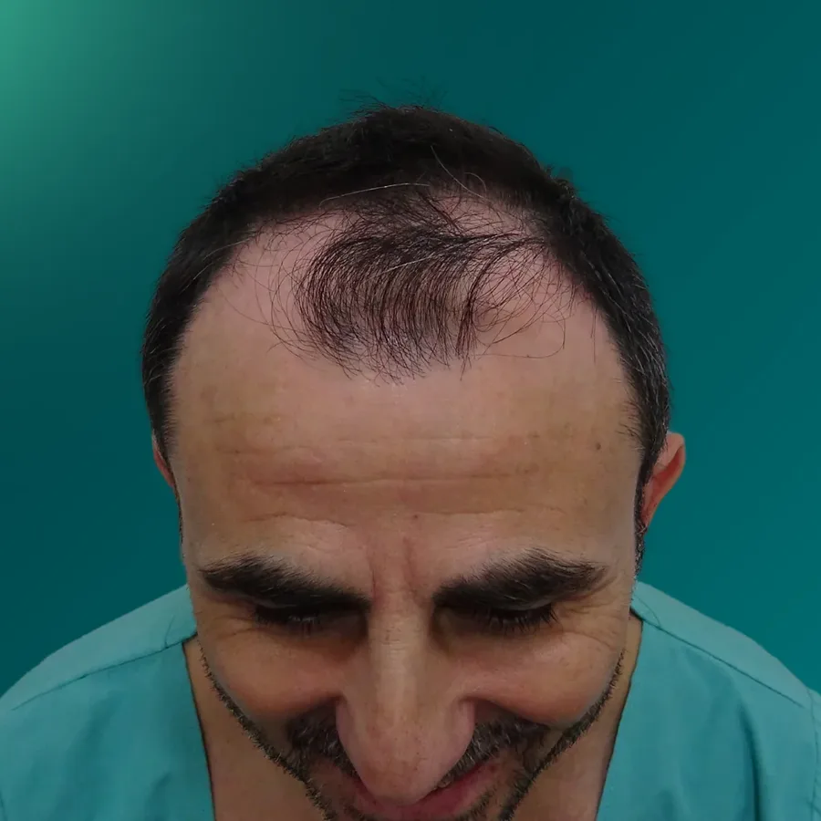 Saç ekimi öncesi