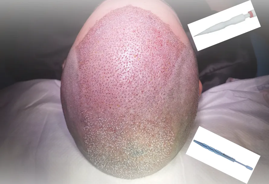 Hybrid (Combined) Hair Transplantation