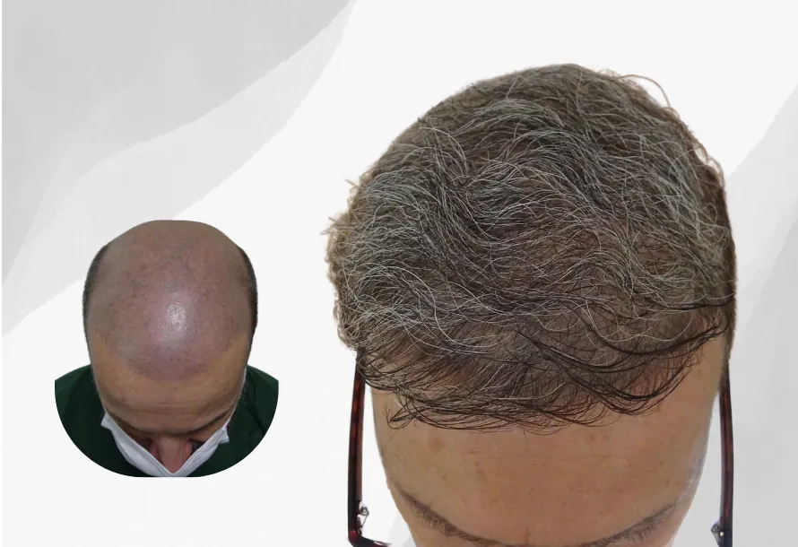 زراعة الشعر بجلسة ميجا