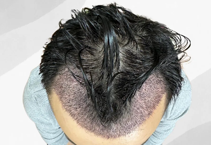 زراعة الشعر بدون حلاقة