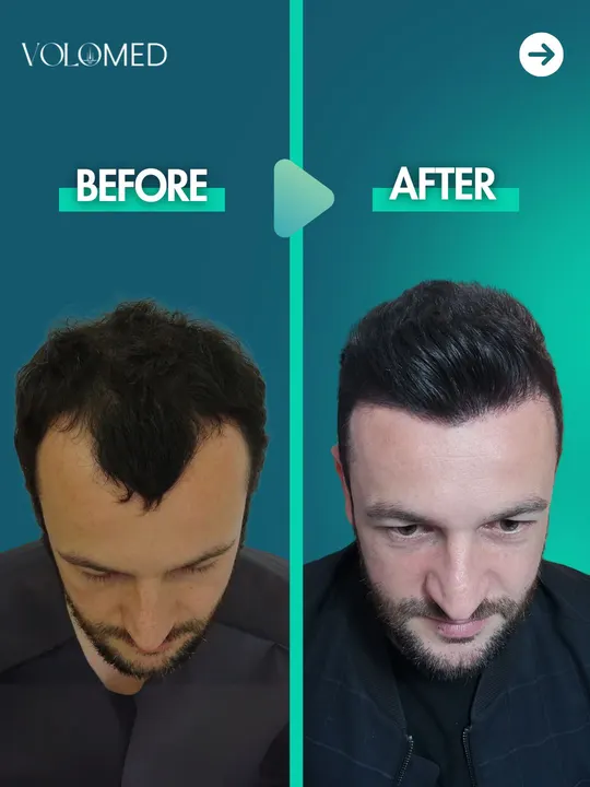 زراعة الشعر: قبل / بعد