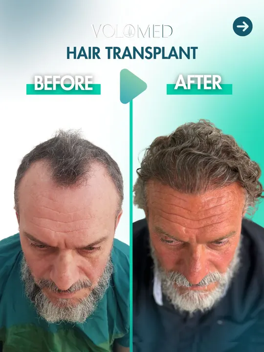 زراعة الشعر: قبل / بعد