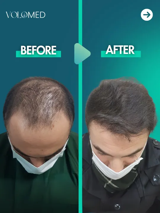 زراعة الشعر: قبل / بعد
