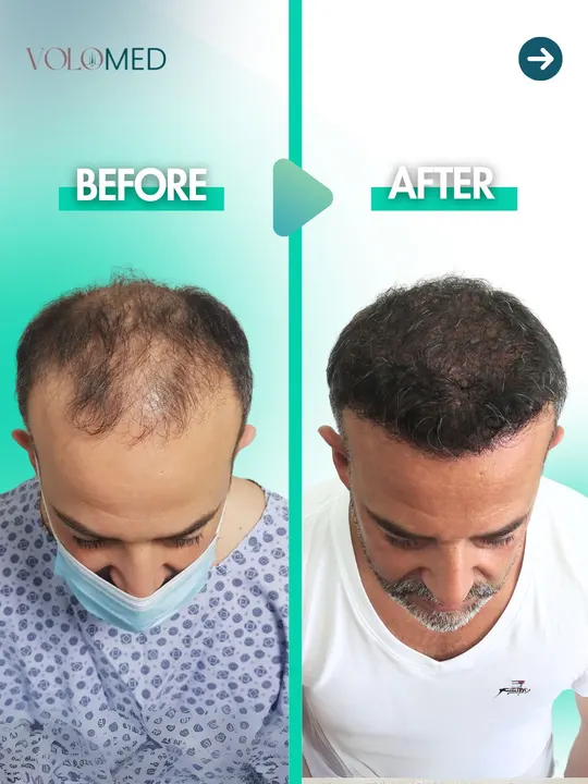زراعة الشعر: قبل / بعد