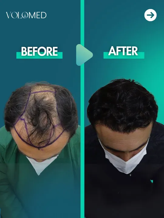 زراعة الشعر: قبل / بعد