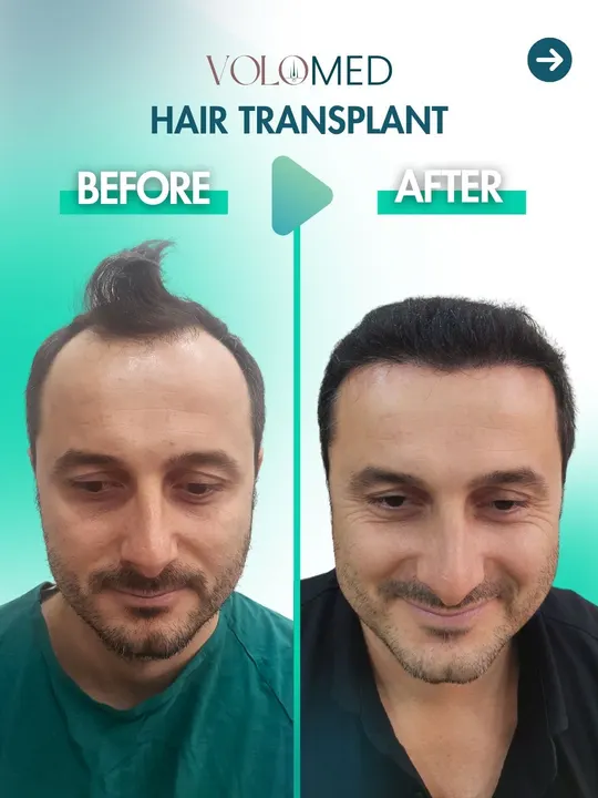 زراعة الشعر: قبل / بعد